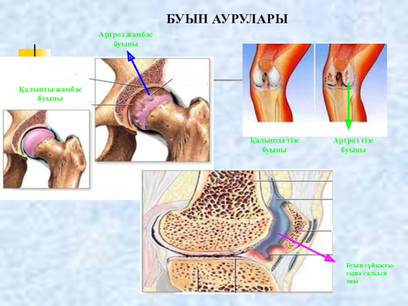 Варикоз Ауруы ?Аза?Ша Хит ?Ндер