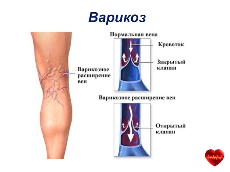 Варикозное Расширение Вен Клиника