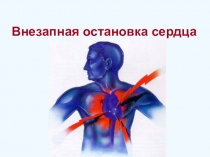 Внезапная остановка сердца.Причина внезапной остановки сердца