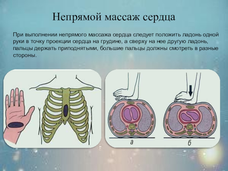 Непрямой сердца. Непрямой массаж сердца техника выполнения. При проведении непрямого массажа сердца ладони следует расположить. При непрямом массаже сердца. Непрямой массаж сердца техника выполнения 1 человеком.