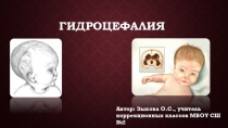 Презентация по теме : Гидроцефалия