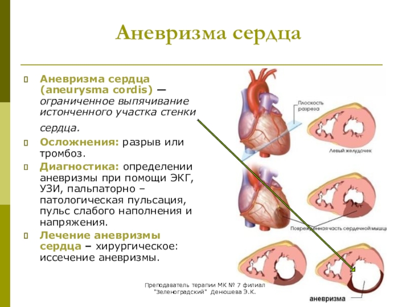 Аневризма сердца фото Ложная аневризма