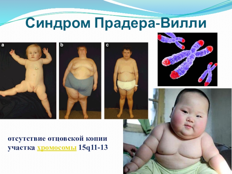 Синдром Прадера-Виллиотсутствие отцовской копии участка хромосомы 15q11-13
