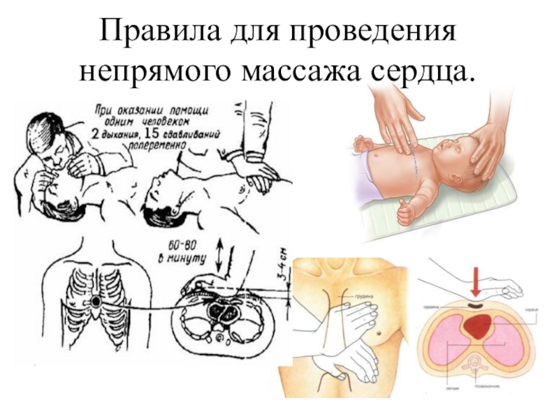 При проведении непрямого. Этапы проведения непрямого массажа сердца. К основным правилам проведения непрямого массажа сердца относятся:. Методика проведения непрямого закрытого массажа сердца. Порядок проведения массажа сердца.