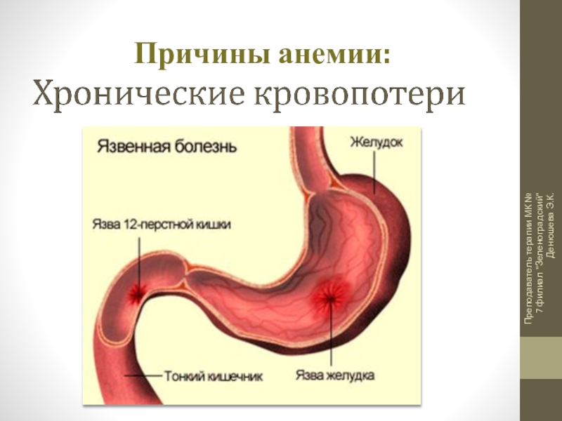 Причины малокровия. Анемия причины возникновения. Анемия при язве желудка. Язык при железодефицитной анемии.