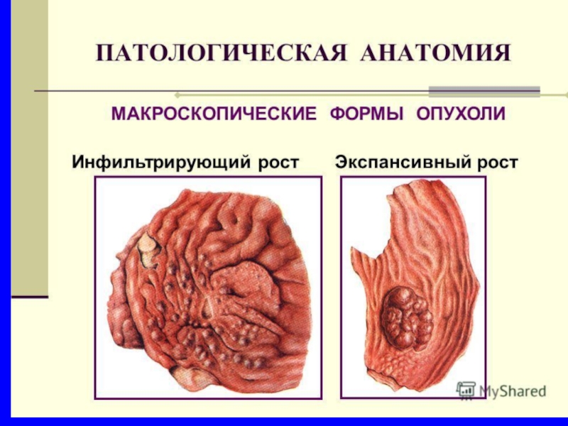 Инвазивный рост опухоли рисунок