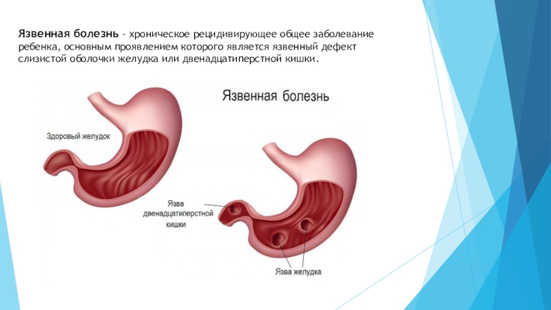 Язвенной болезни желудка презентация