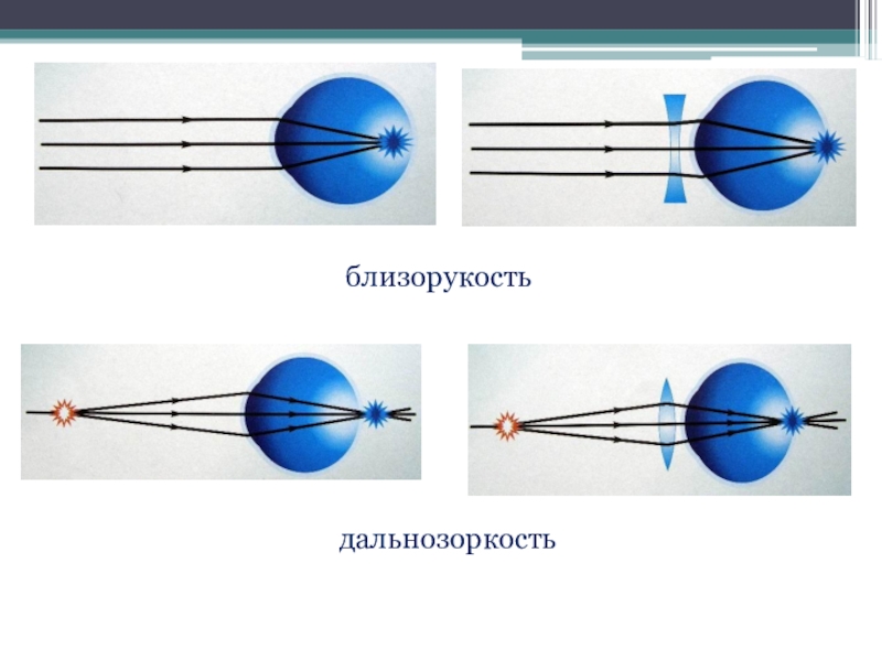 Дальнозоркость презентация физика