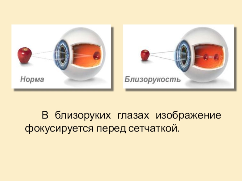 Если изображение фокусируется перед сетчаткой глаза возникает