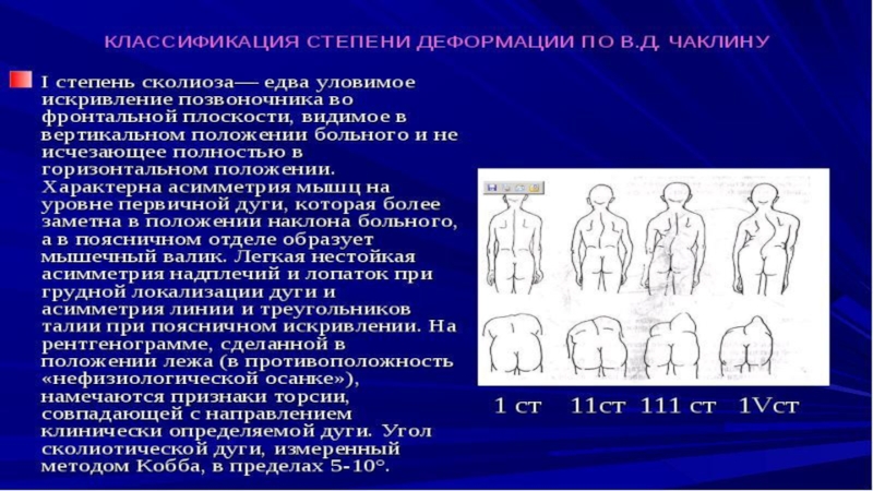 10 степень сколиоза. Сколиоз 2 степени по чаклину. Деформация позвоночника по чаклину. Классификация сколиоза по чаклину таблица. К третьей степени сколиотической деформации позвоночника по чаклину.