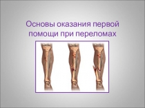 Основы оказания первой помощи при переломах. 10 класс. Презентация.