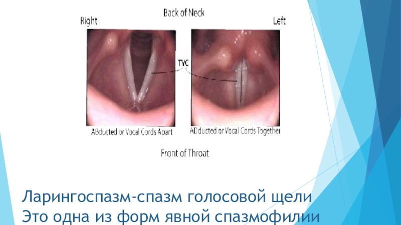 Ларингоспазм у детей презентация