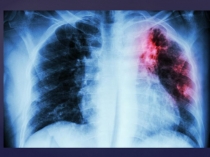 Презентация по биологии в формате Pecha-Cucha на тему Туберкулёз 8 класс