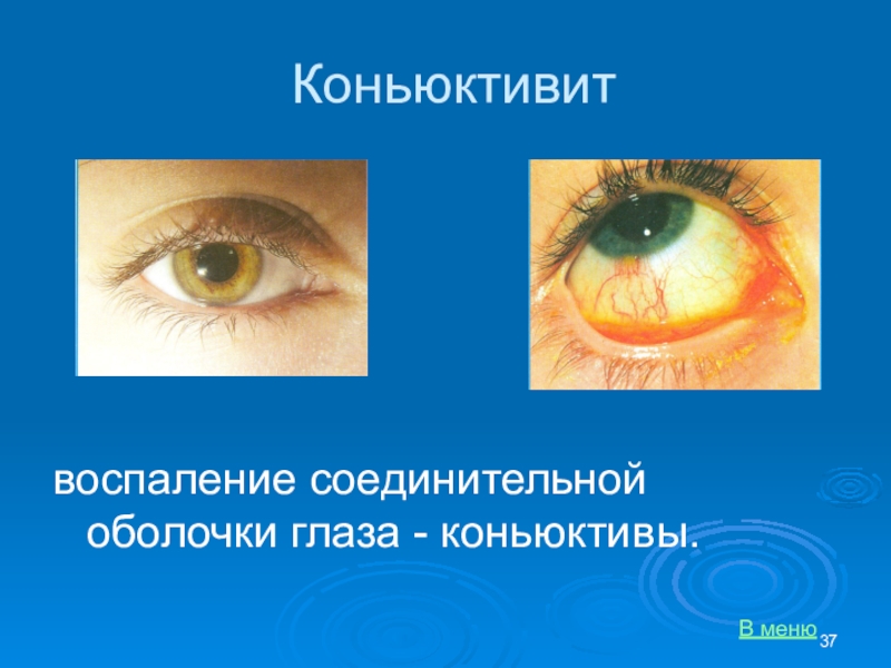 Лечение коньюктивита. Соединительная оболочка глаза. Воспаление оболочки глаза. Воспаление коньюктивин. Воспаление соединительной оболочки глаз.