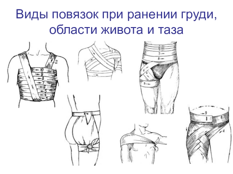 Повязки при ранениях. Виды повязок при ранениях. Наложение повязки при ранении. Вид повязки при ранении груди.