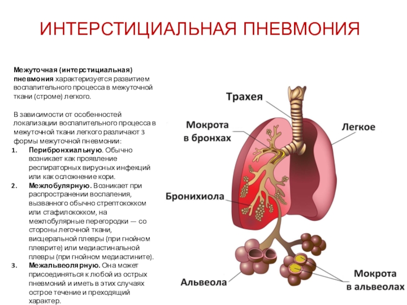 Легочный интерстиций. Осложнения интерстициальной пневмонии. Формы межуточной пневмонии. Интерстициальная пневмония исход. Интерсти иальная пневмония.