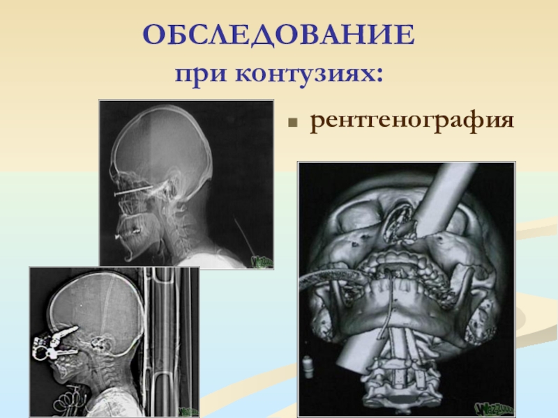 Что такое контузия. Обследование при контузии.