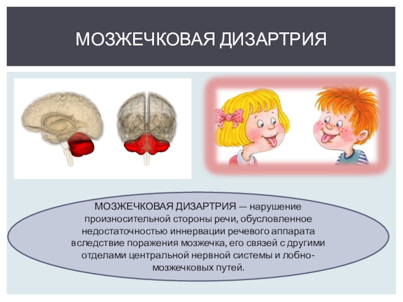 Мозжечковая дизартрия это