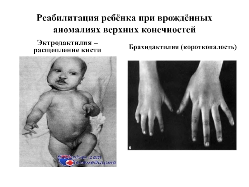 Реабилитация ребёнка при врождённых аномалиях верхних конечностейЭктродактилия – расщепление кистиБрахидактилия (короткопалость)