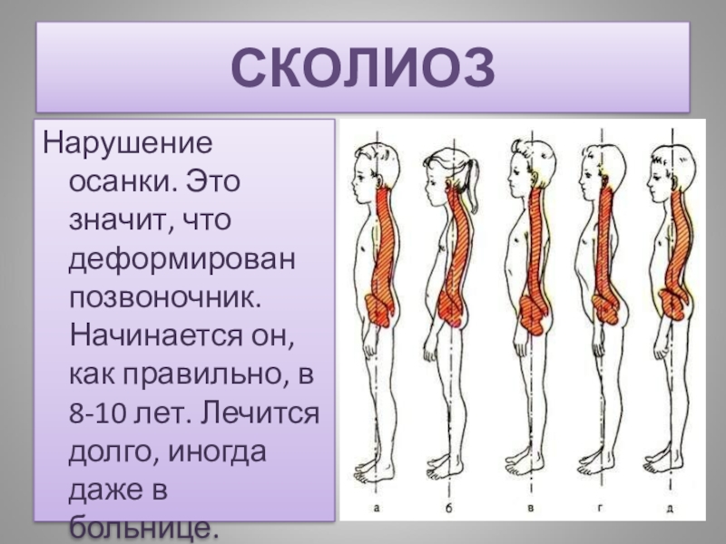 Сколиотическая осанка. Сколиоз осанка. Сколиотическое нарушение осанки. Сколиоз и сколиотическая осанка. Сколиотическая осанка позвоночника.