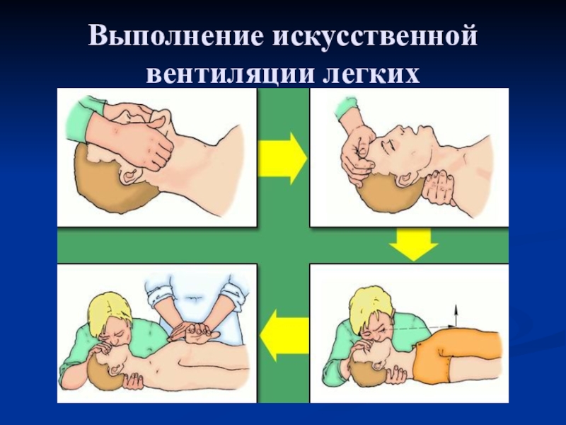 Проведение искусственной вентиляции. ИВЛ техника проведения. Искусственная вентиляция легких выполняется. Техника проведения искусственной вентиляции легких. Признаком правильного выполнения ИВЛ.