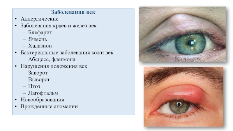 Лечение заболеваний век. Конъюнктивит век ячмень блефарит. Заболевание глаз блефарит. Блефариты аллергический век.