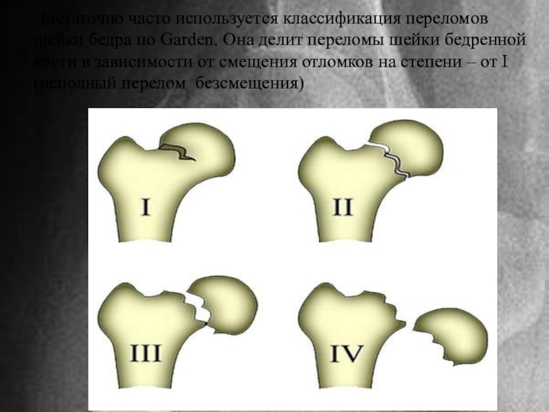 Карта вызова смп перелом бедренной кости