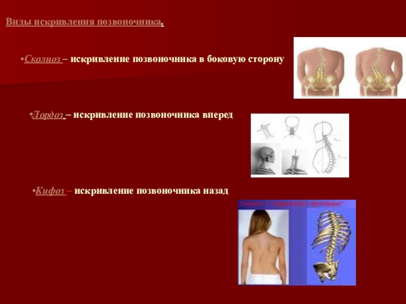 Нарушение осанки и плоскостопие. Нарушениях осанки, сколиозах и плоскостопии. Сколиоз позвоночника презентация. Сколиоз позвоночника биология. Искривление осанки и плоскостопие.