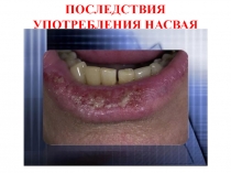 Презентация по ОБЖ на тему Последствия употребления насвая (10 класс)