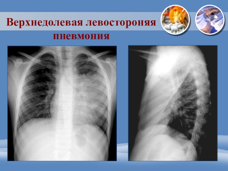 Реферат: История болезни - терапия (острая очаговая сливная верхнедолевая пневмония)