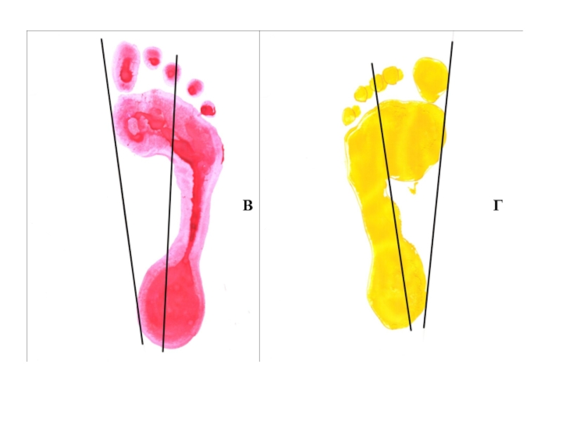 Плоскостопие биология. Плоскостопие плантография. Плантограмма по чиживу. Выявление плоскостопия по биолог. Плантография стопы.