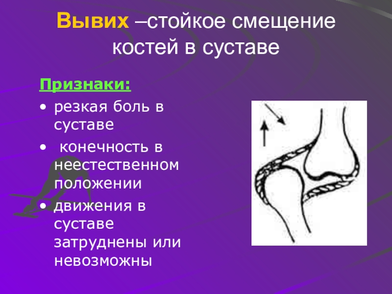 Вывих кости