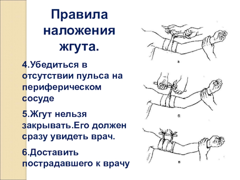 Жгут на конечность при кровотечении. Основные принципы наложения жгута. Пять правил наложения жгута. 6 Основных правил наложения жгута. При наложении кровоостанавливающего жгута нельзя ….