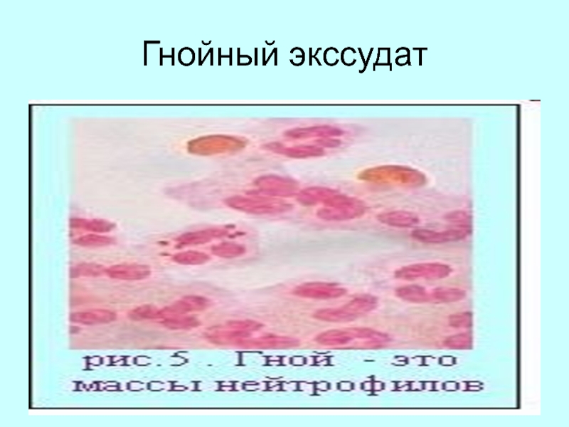 При гнойном остром воспалении наблюдается изменение картины крови