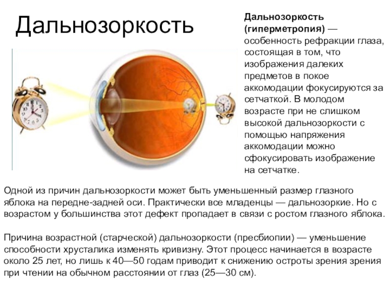 Рефракция глаза характеристика изображения на сетчатке