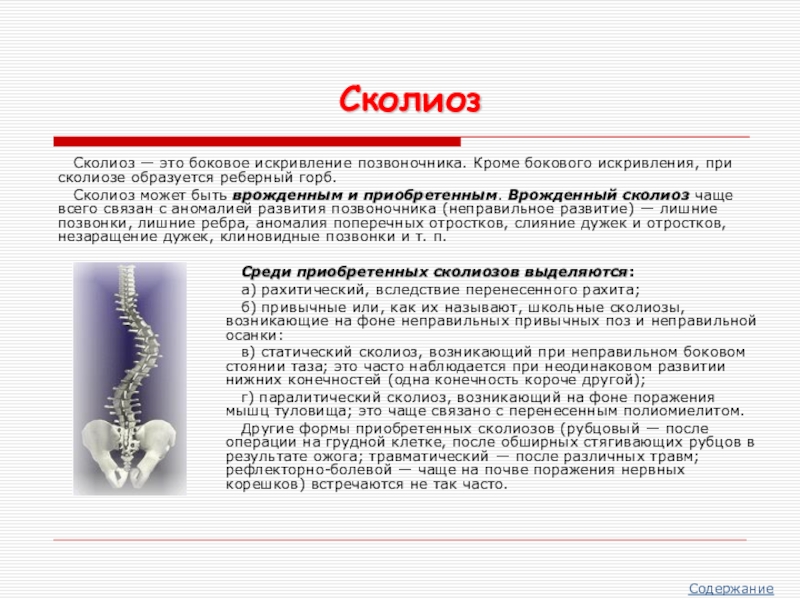 Презентация на тему сколиоз