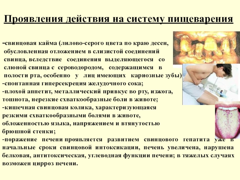 Сатурнизм это. Профилактика свинцовой интоксикации. Зубы при свинцовой интоксикации.