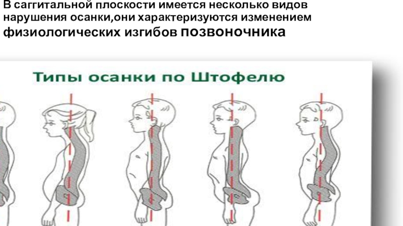 Фронтальная плоскость позвоночника. Задачи ЛФК при нарушениях осанки во фронтальной плоскости. Нарушение осанки во фронтальной плоскости. Изгибы позвоночника во фронтальной плоскости. Дефекты осанки с увеличением физиологических изгибов позвоночника..