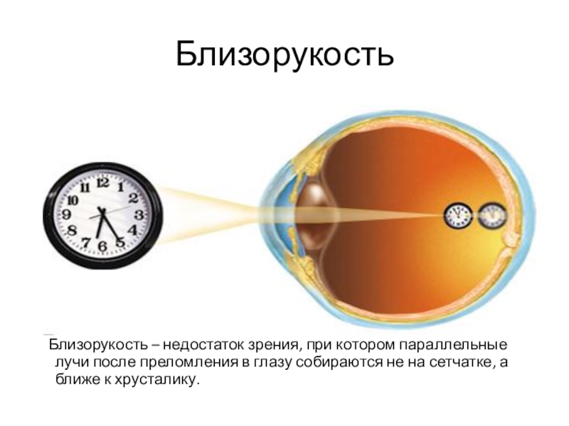 Дефект зрения презентация