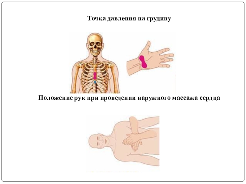 Смещение грудины при массаже сердца