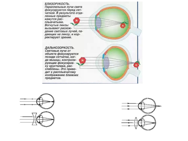 В случае близорукости хрусталик фокусирует изображение перед сетчаткой или за сетчаткой