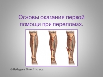 Презентация к уроку ОБЖ Переломы 11 класс