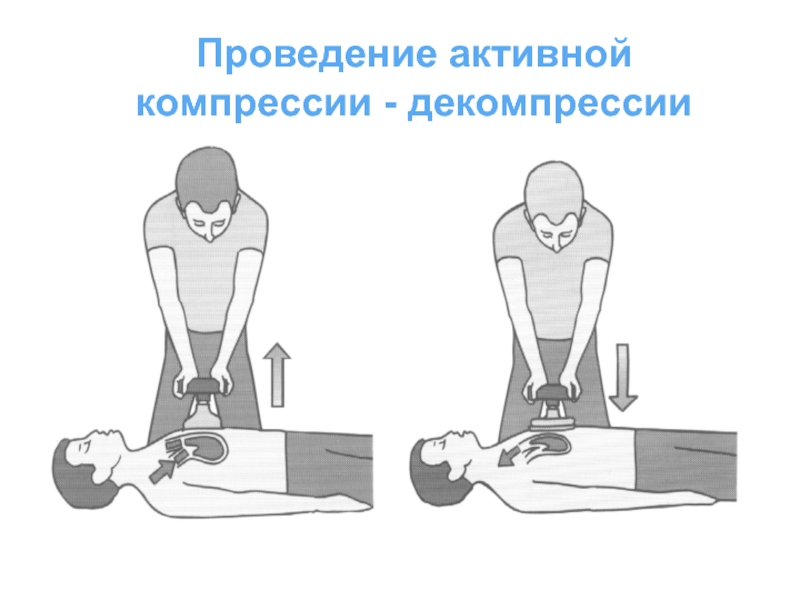 При проведении компрессии. Компрессия и декомпрессия. Активная компрессия-декомпрессия.