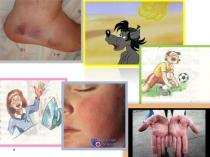 Тема урока: Оказание первой помощи при тепловом и солнечном ударе, отморожении и ожоге (термическом ожоге) (6 класс)