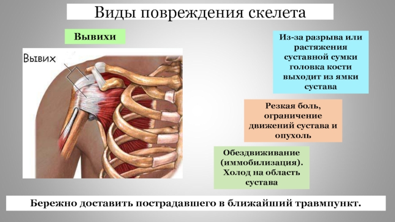 Переломы скелета. Типы повреждения скелета. Первая помощь при повреждении скелета.