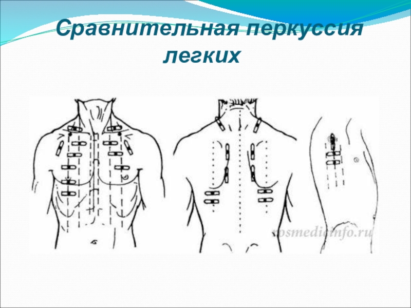 Схема сравнительной перкуссии легких