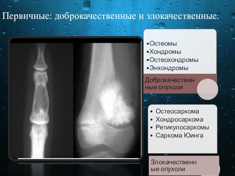 Доброкачественные опухоли костей презентация