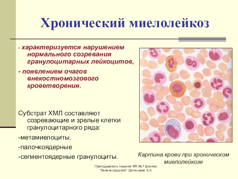 Картина крови при хроническом миелолейкозе