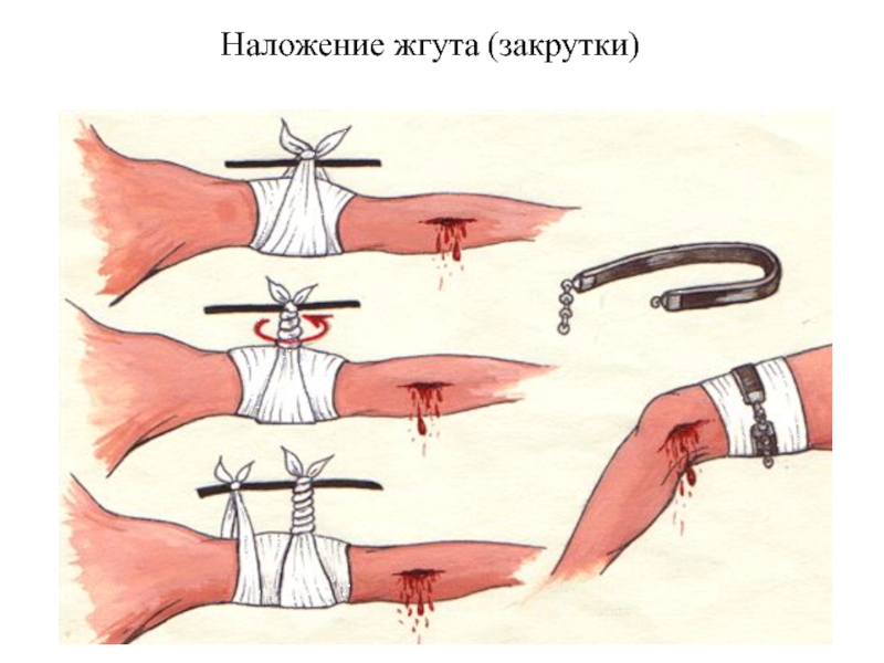 Какое кровотечение изображено на рисунке 1 и 2 чем отличаются