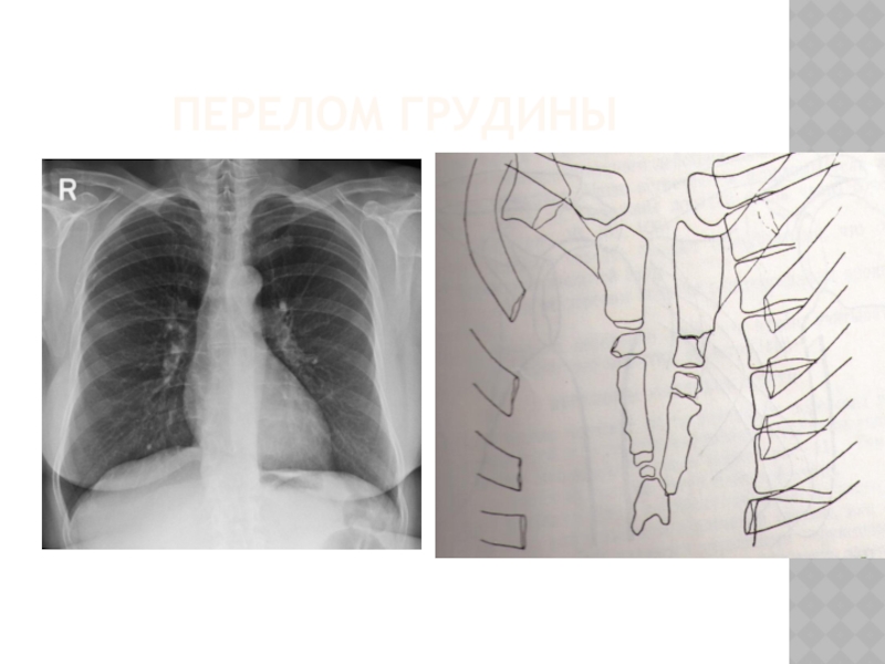 Перелом грудины презентация